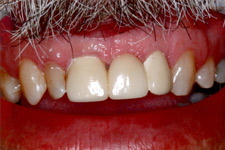 Bonding & Veneer - After