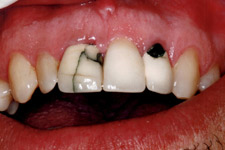 Bonding & Veneer - Before