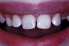 Bonding & Veneer - After
