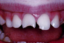 Bonding & Veneer - Before