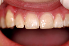 Bonding & Veneer - After