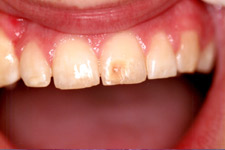 Bonding & Veneer - Before