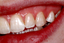 Bonding & Veneer - After