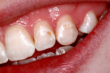 Bonding & Veneer - Before