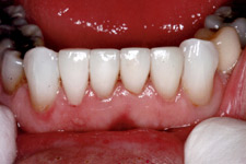 Bonding & Veneer - After