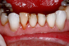 Bonding & Veneer - Before