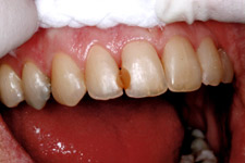 Bonding & Veneer - Before