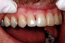 Bonding & Veneer - After