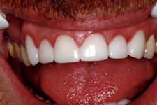 Bonding & Veneer - After