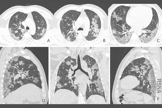 photo of coronavirus lung
