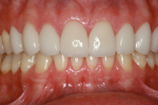 Bonding & Veneer - After