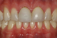 Bonding & Veneer - Before