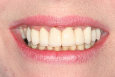 Female Smile Makeover - After