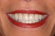 Female Veneer - After