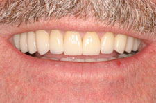 Full Mouth Reconstruction - After