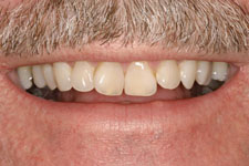 Full Mouth Reconstruction - Before