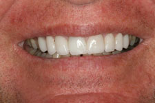 Male Smile Makeover 01 - After