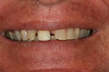 Male Smile Makeover 01 - Before