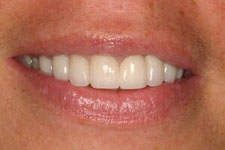 Male Smile Makeover 02 - After