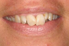 Male Smile Makeover 02 - Before