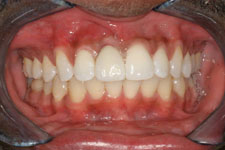 Single Implant - After