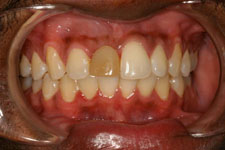 Single Implant - Before