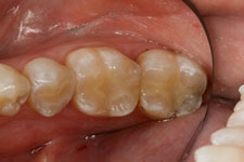 Tooth Colored Filling 02 - After