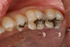 Tooth Colored Filling 02 - Before
