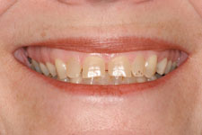 Veneers & Crowns - Before
