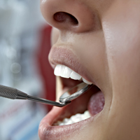 porcelain or metal fillings