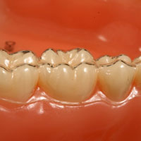 dental impression.jpg