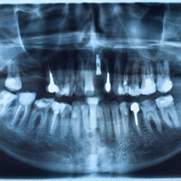 Dental X-Rays