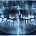 Dental X-rays: What Do They Show?