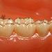 Getting a Dental Impression? Here's What to Expect
