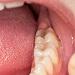 Dental Fillings: What are Your Options?