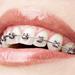 Your Orthodontic Options: Types of Braces
